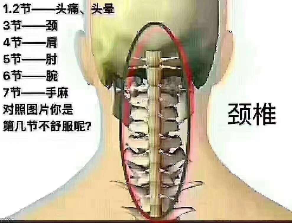 颈椎1-2椎:头痛,头晕,头昏,耳鸣 颈椎2-3椎:头昏,咽部不适,后背酸胀