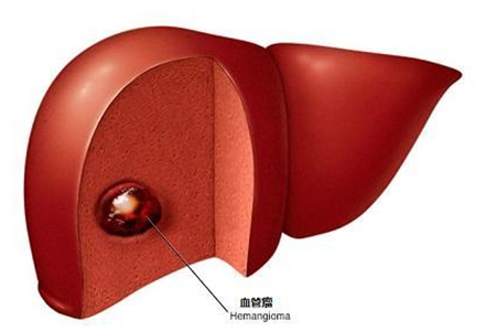 体检发现肝血管瘤它的病因有哪些需要治疗吗