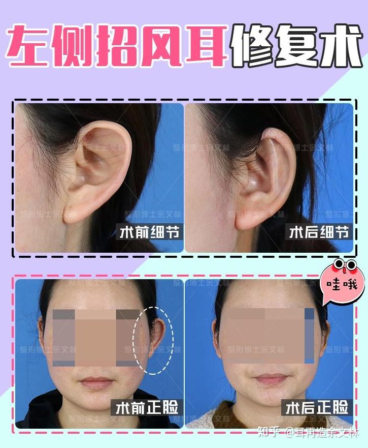 招风耳也是畸形的一种几岁做招风耳矫正比较好