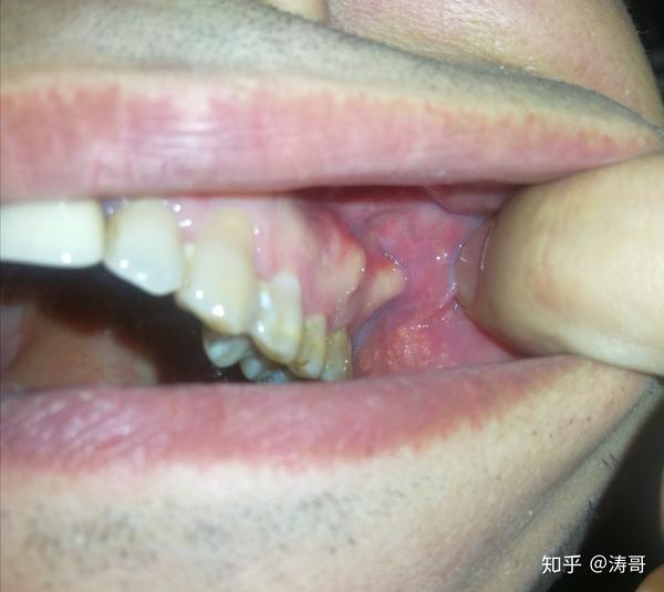 这是牙龈骨质增生吗?