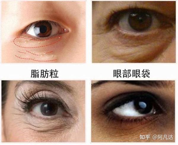 40岁之后这些眼部问题应该怎么解决呢