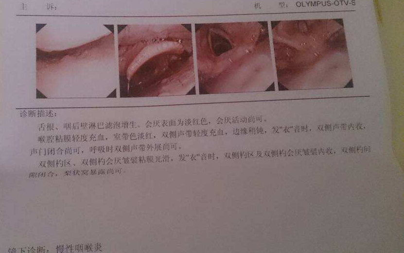 久治不愈反反复复的慢性咽炎可能是胃食管反流引起