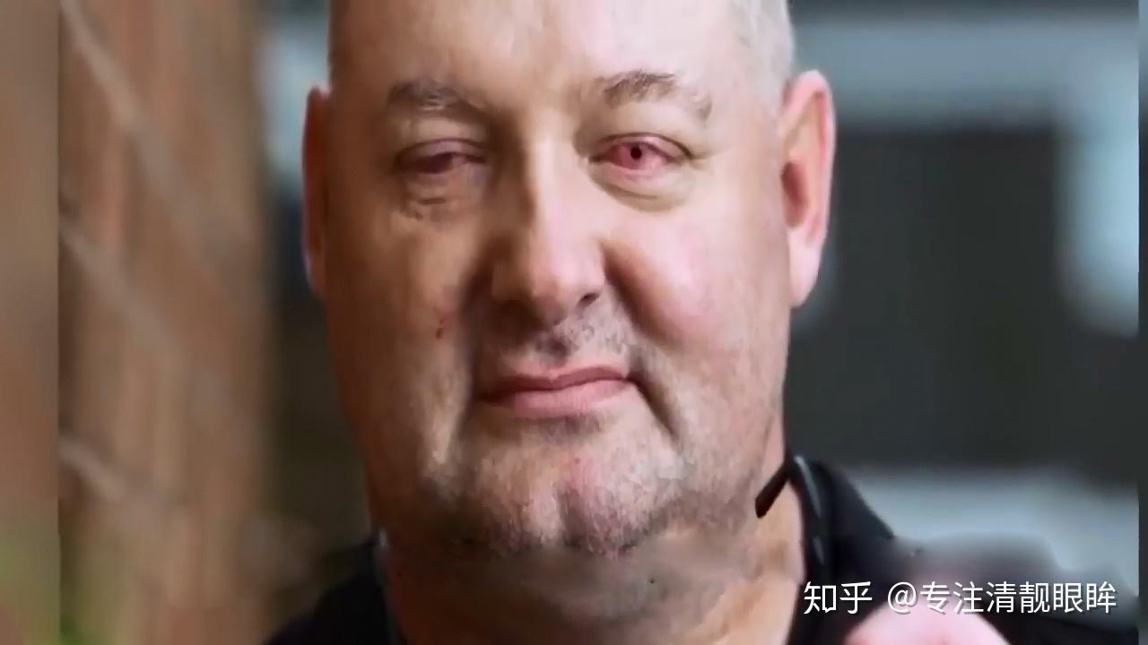眼睛内长牙齿可能是你一辈子都不会想到的事情,但这在世界上却真实的