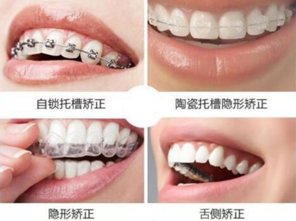 上海整牙丨齿科医院正畸医生牙套选择全攻略上海牙齿矫正正畸避坑必看