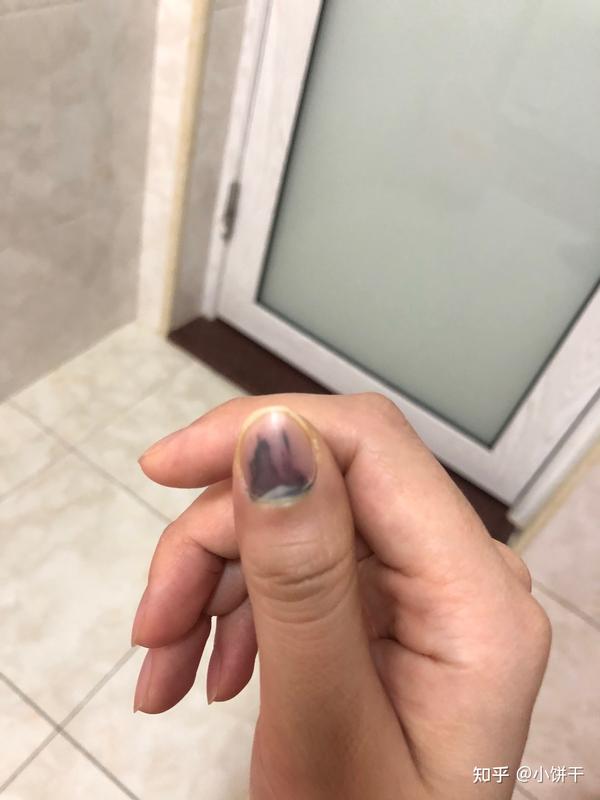 手指被车门夹了后