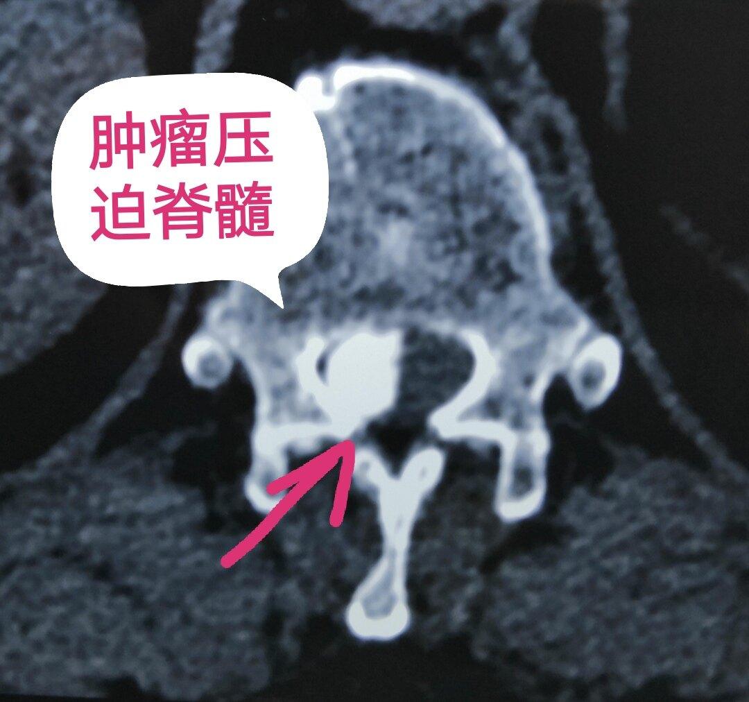 像骨头样硬的肿瘤压迫脊髓到底是什么肿瘤?