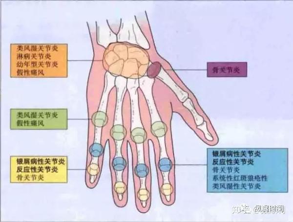 银屑病与银屑病关节炎下