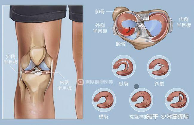 膝关节的半月板受到损伤后,会出现很多的症状,严重影响正常的行走