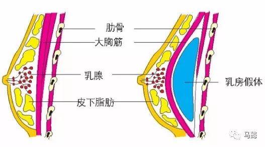 假体隆胸手术切口,常见的有三种:腋窝切口,乳晕切口,乳房下皱襞切口.