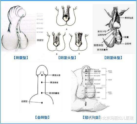 典型尿道下裂有三个特点:尿道口异常,阴茎弯曲程度不同,包皮分布不