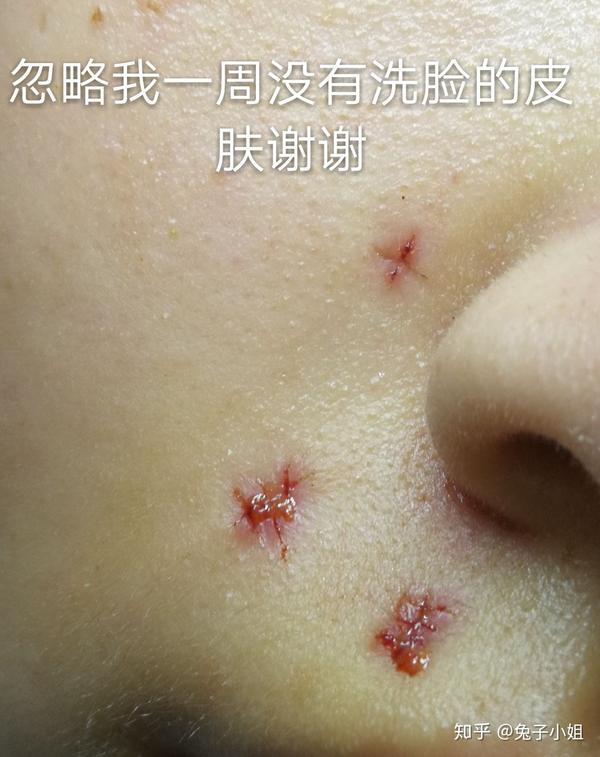 手术切痣是一种怎样的体验