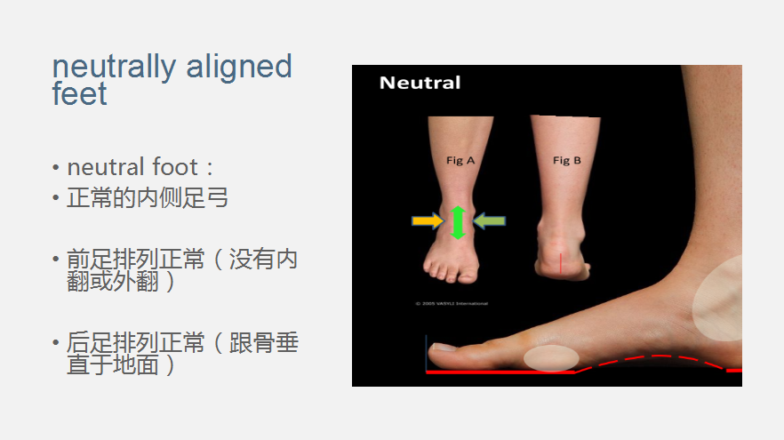 over pronation指的是脚掌向外翻转;即足外翻,大部分会有足弓塌陷