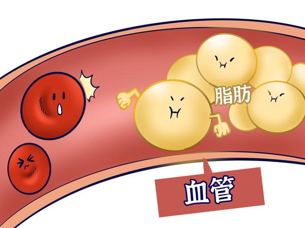 高脂血症本身没有太多症状,但可能会引发 动脉粥样硬化,冠心病,脑卒中