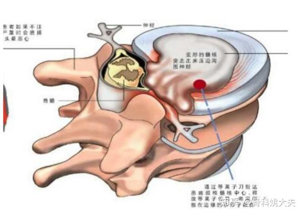 腰椎间盘膨出,怎样的睡姿对腰好?