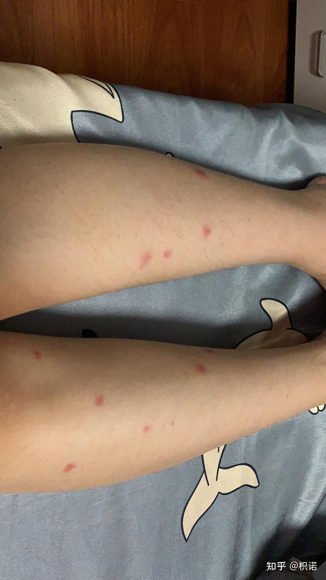 记录一次触目惊心被蚊子咬的经历