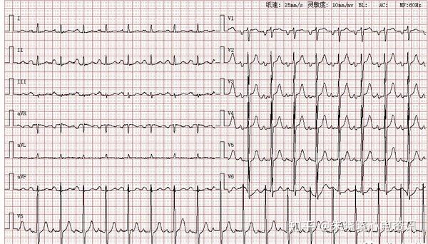 窦性心动过速 2.二尖瓣型p波 3.左心室高电压 4.