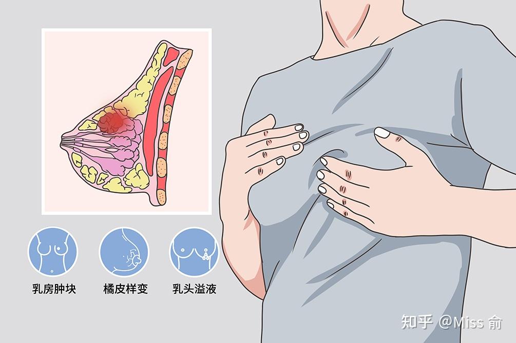 广州隆胸做自体脂肪还是做假体分析广州隆胸优势医生技术风格