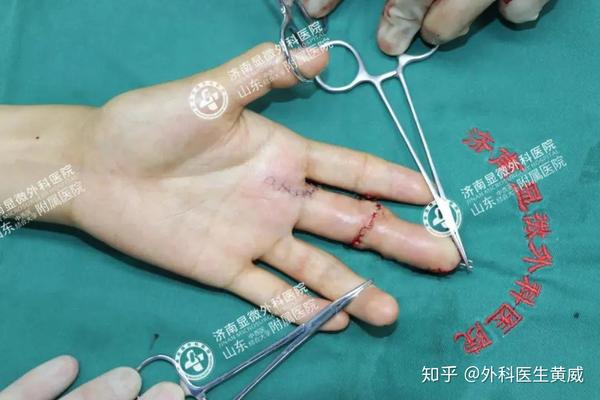 【近期案例合集】不同程度的手指缺损,这个再造手术给