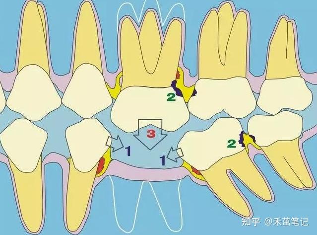 缺牙两年后牙槽骨会不会被吸收