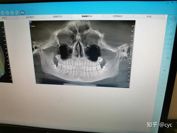 拍了ct才知道牙齿越来越突出的原因:肉里长了四颗智齿,学名阻生齿.