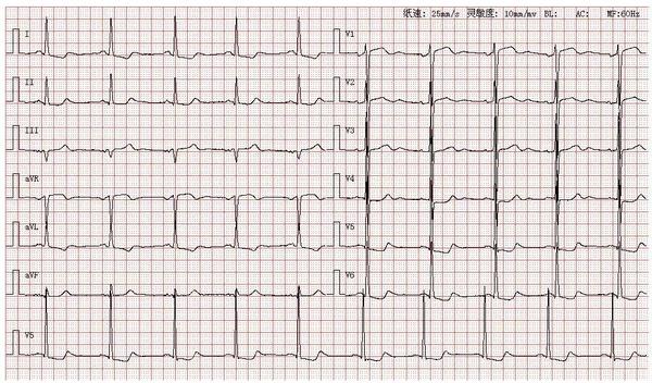 心电图图库丨左室大左室高电压