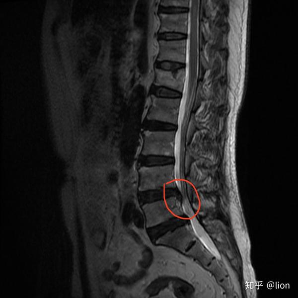 腰椎核磁可见到l4-5椎间盘突出并向尾端移位
