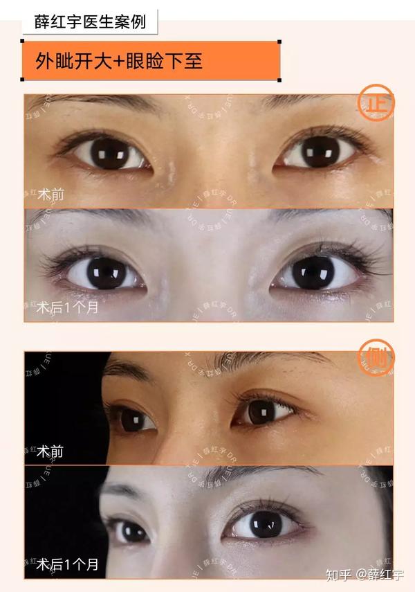 做双眼皮一定要开外眼角眼睑下至是什么