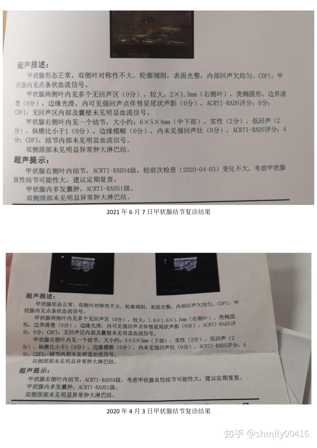 甲状腺结节4c zhuanlan.zhihu.com