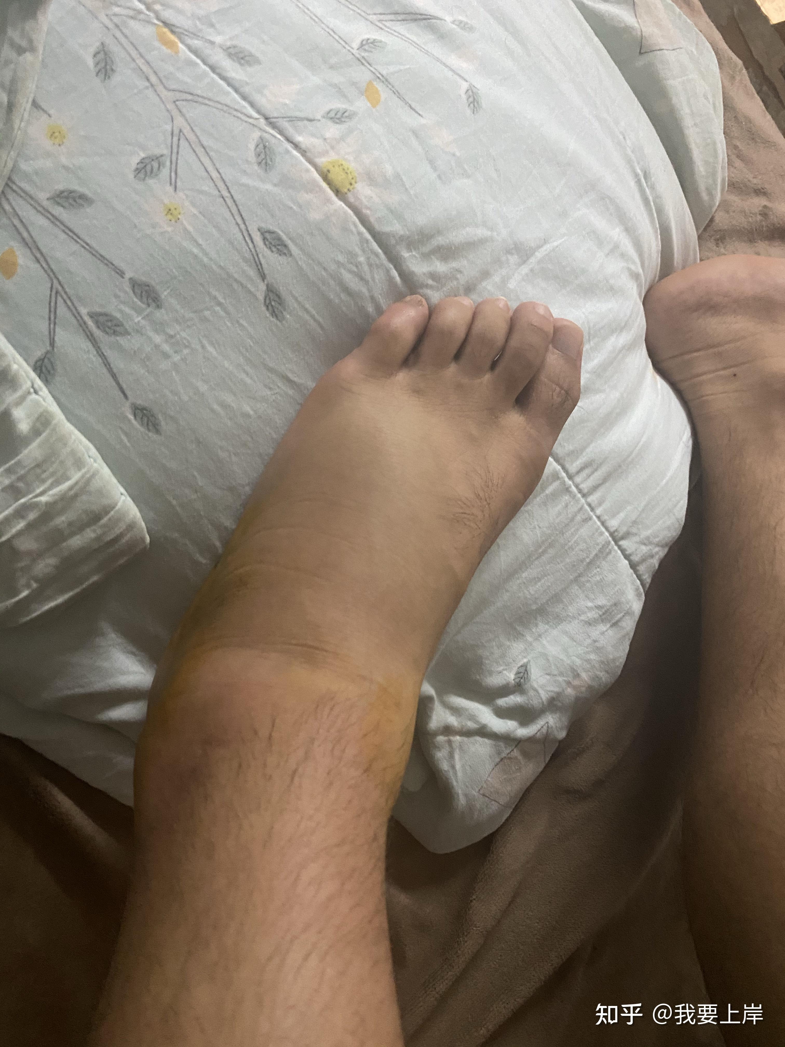 脚崴了肿了如果不及时处理会怎样