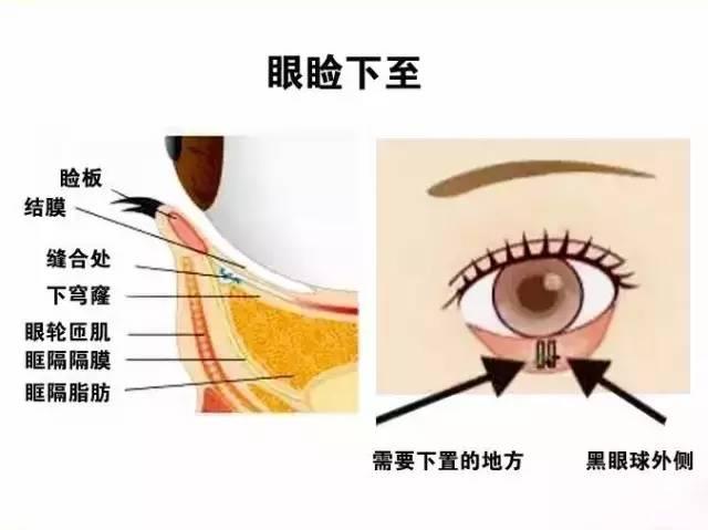 注意!经常做这个动作的人,小心"睑内翻"找上你!