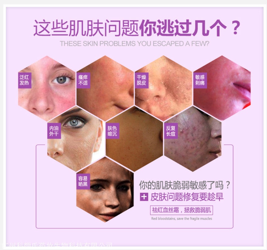 激素脸怎么判断程度轻重: 1,轻度激素脸: 有过上面1-3的经历,但皮肤