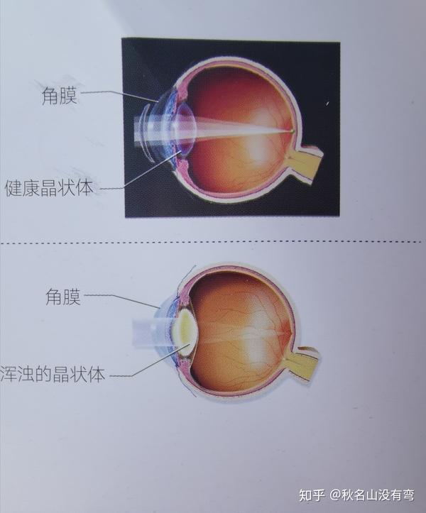 白内障知识分享