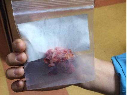 巧克力囊肿有什么症状?要不要手术?饮食禁忌有哪些?带
