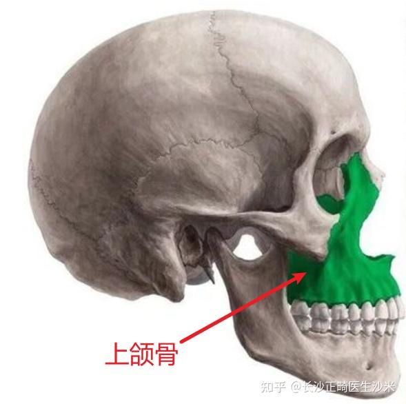 4, 骨性问题——上颌骨垂直向发育过度或上颌骨突出,牙龈包裹不住上颌