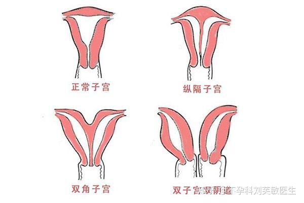 子宫畸形并不可怕,能否怀孕,与其类型密切相关.