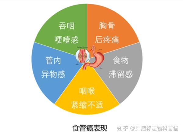 食管癌的临床表现 (1)症状:吞咽食物时有哽咽感,异