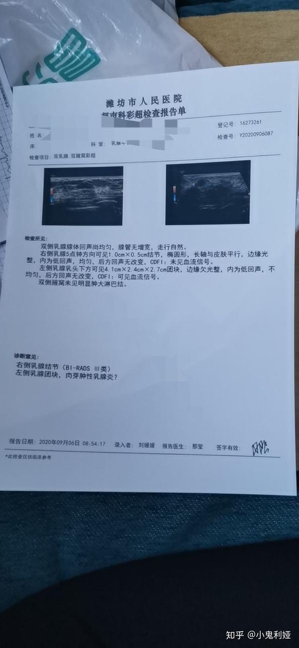 肉芽肿乳腺炎一个多月就被治愈了,开心到爆炸