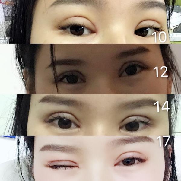 割双眼皮手术(去脂去皮开内眼角提肌)一感一受分享