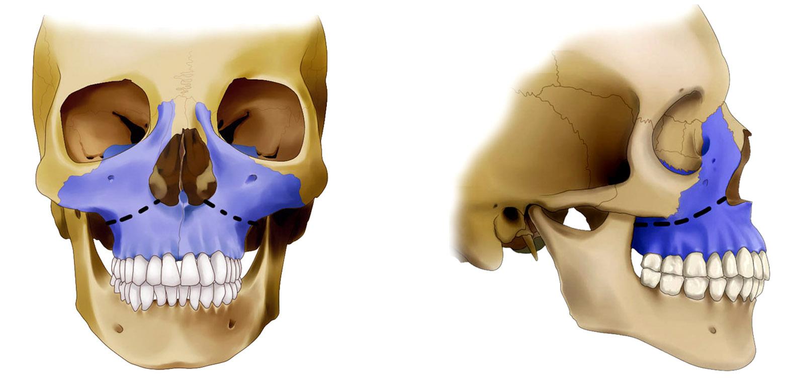 牙颌面畸形,是由颌骨生长发育异常所引起的颌骨体积,形态,以及上下颌