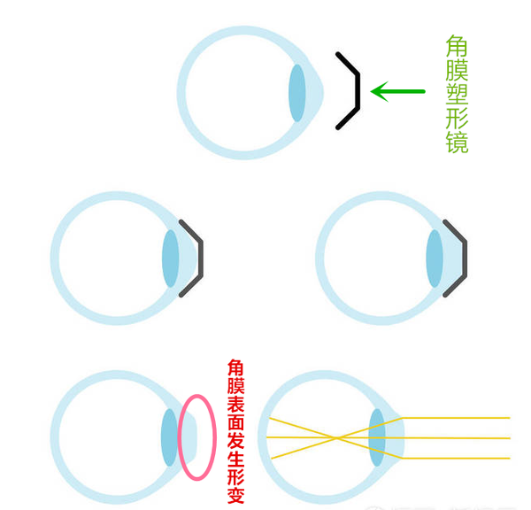 眼科专家认可的角膜塑形镜,你居然不知道?