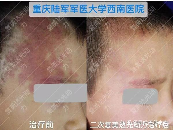 青少年鲜红斑痣治疗前后对比图:充分利用寒暑假,积极治疗前途佳