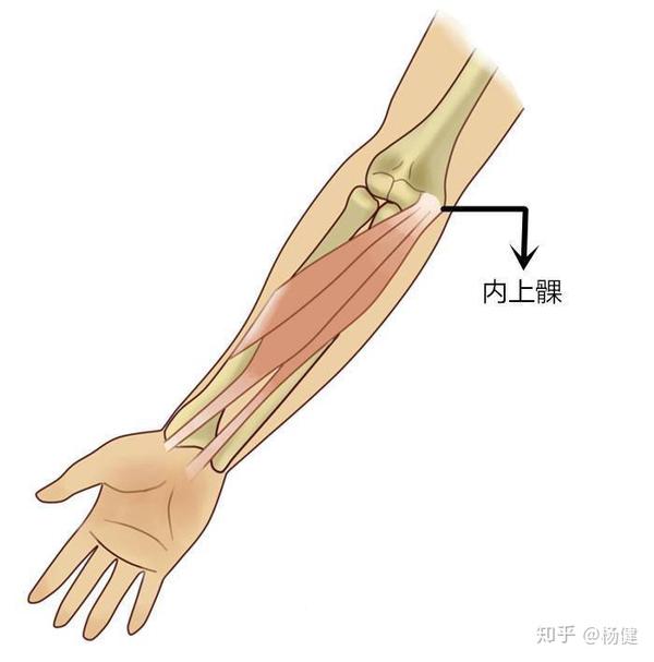 肱骨内上髁炎,又叫"高尔夫球肘",因常发生于高尔夫球运动中而得名