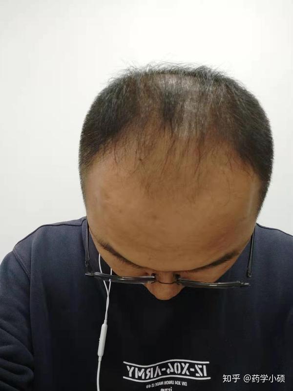 记录下使用米诺地尔酊后的变化