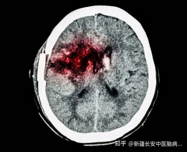 痛心年仅24岁研究生突发脑出血去世当身体出现这6大症状或是脑出血