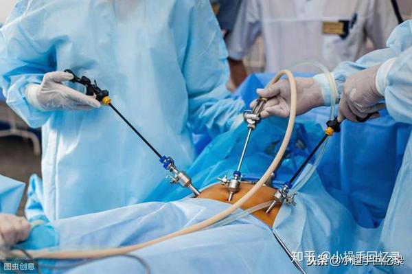 腹腔镜下胆囊切除术:腹壁上打三个孔,通过内部摄像头辅助操作切除胆囊