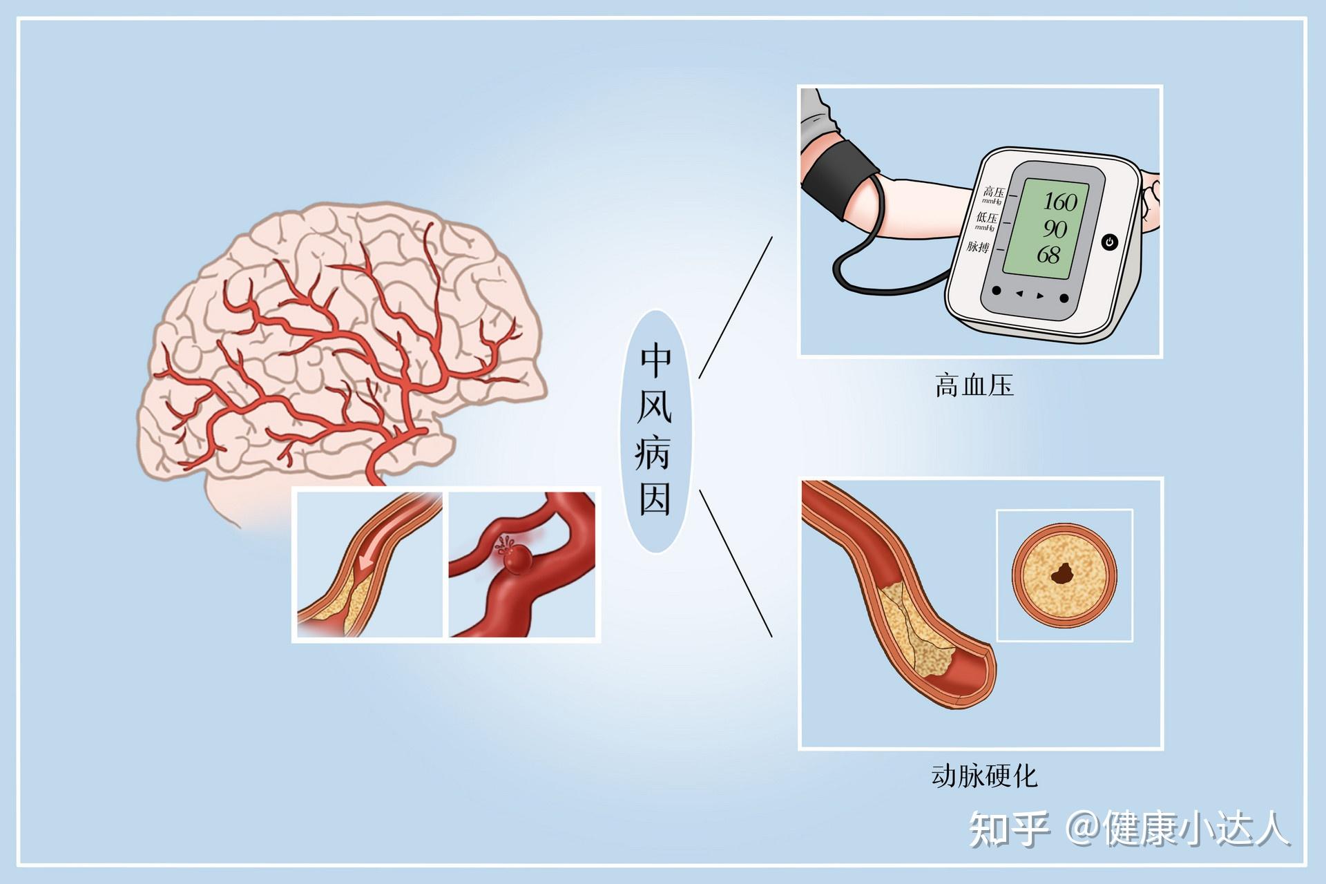 全球每5秒发生1例的脑卒中如何治疗成为关键