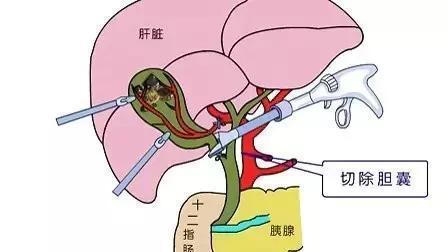 胆囊息肉怎么治疗?