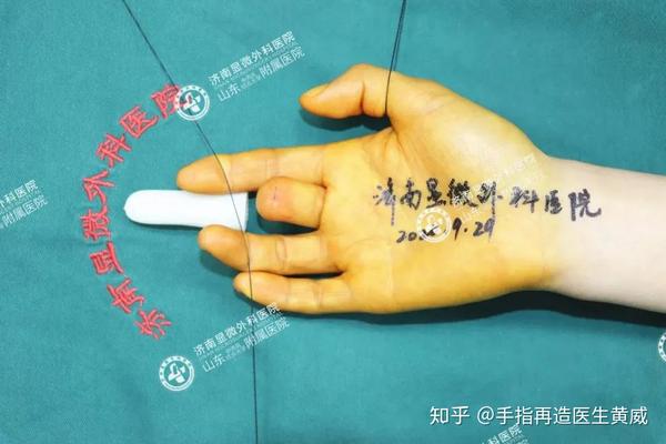 见证奇迹 | 多例手指再造手术全部成活!