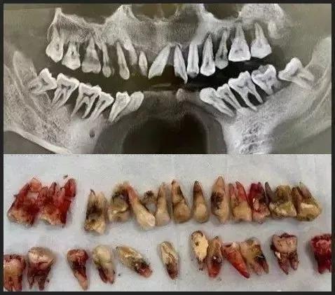 30多岁的小伙子因牙齿松动就诊结果全口牙齿都要拔掉