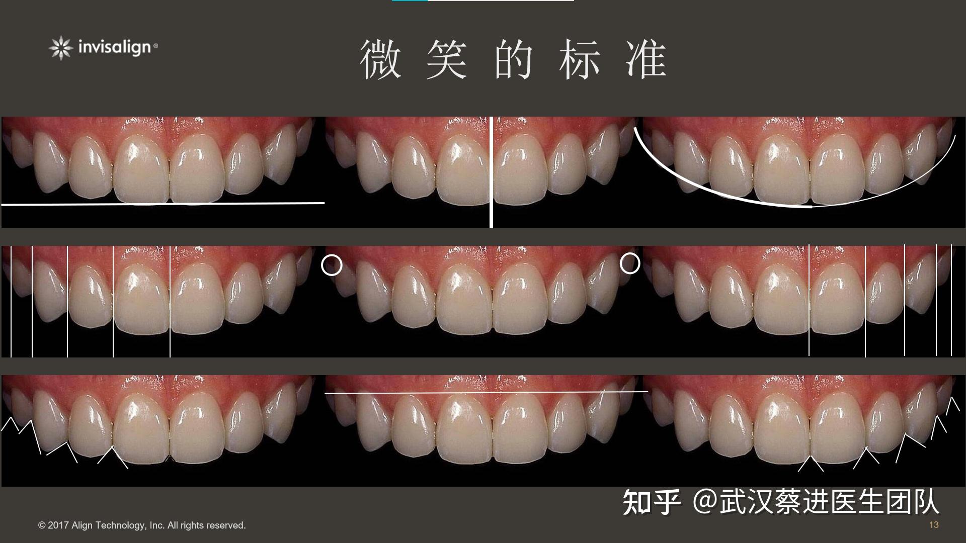 整体面型的垂直向发育,通过拔牙矫正,内收上下前牙,整平下颌 spee曲线